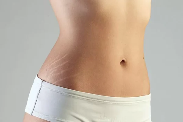 Stretch-Marks