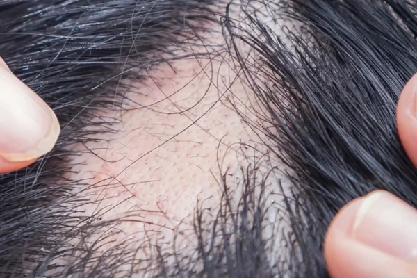 alopecia_areata_img-768x1232