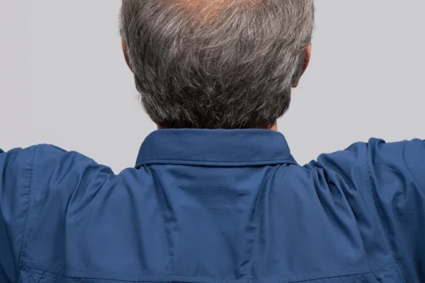 androgenetic_alopecia_img-768x1232