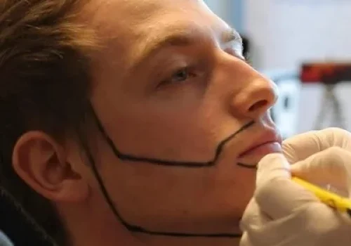 beard_transplantation_img-1