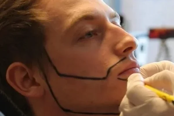 beard_transplantation_img-1