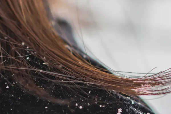 dandruff_img-638x1024