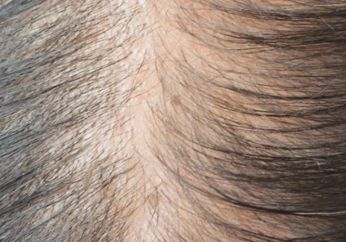 hair_loss_img-768x1232