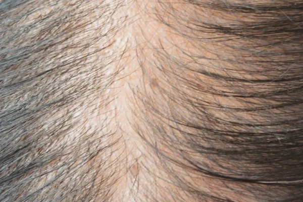 hair_loss_img-768x1232