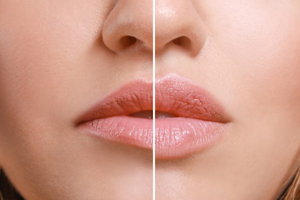 Young woman before and after lip enhancement, closeup