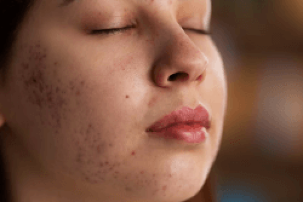 melasma