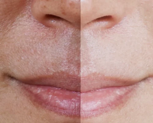 melasma_img-768x1232