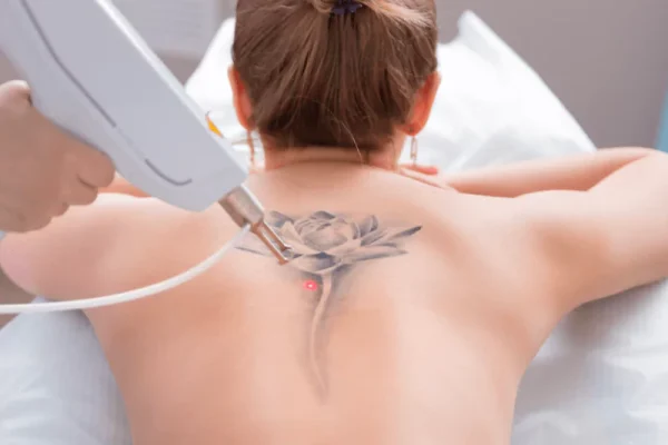 tattoo-removal-edmonton-ab-ca-64ef5eb427def