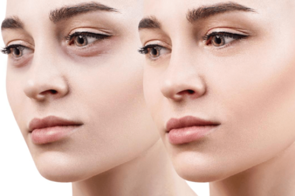 under-eye-fillers-min-e1569204321694