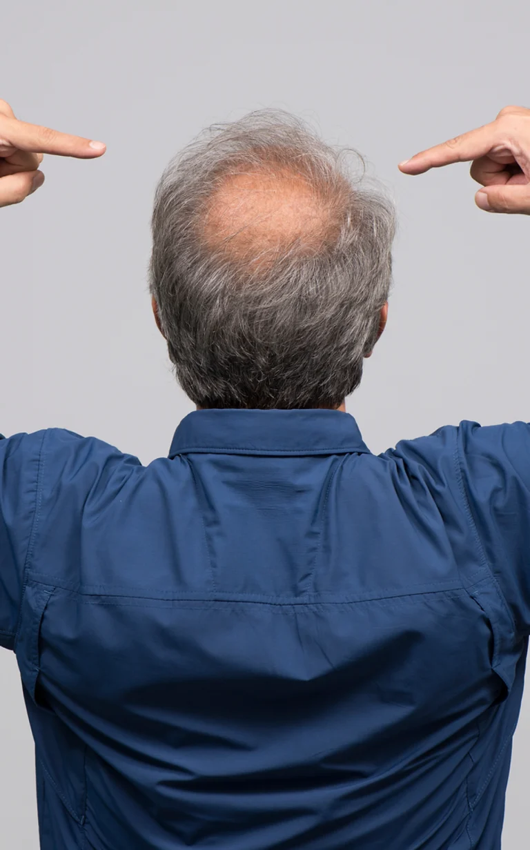 androgenetic_alopecia_img-768x1232
