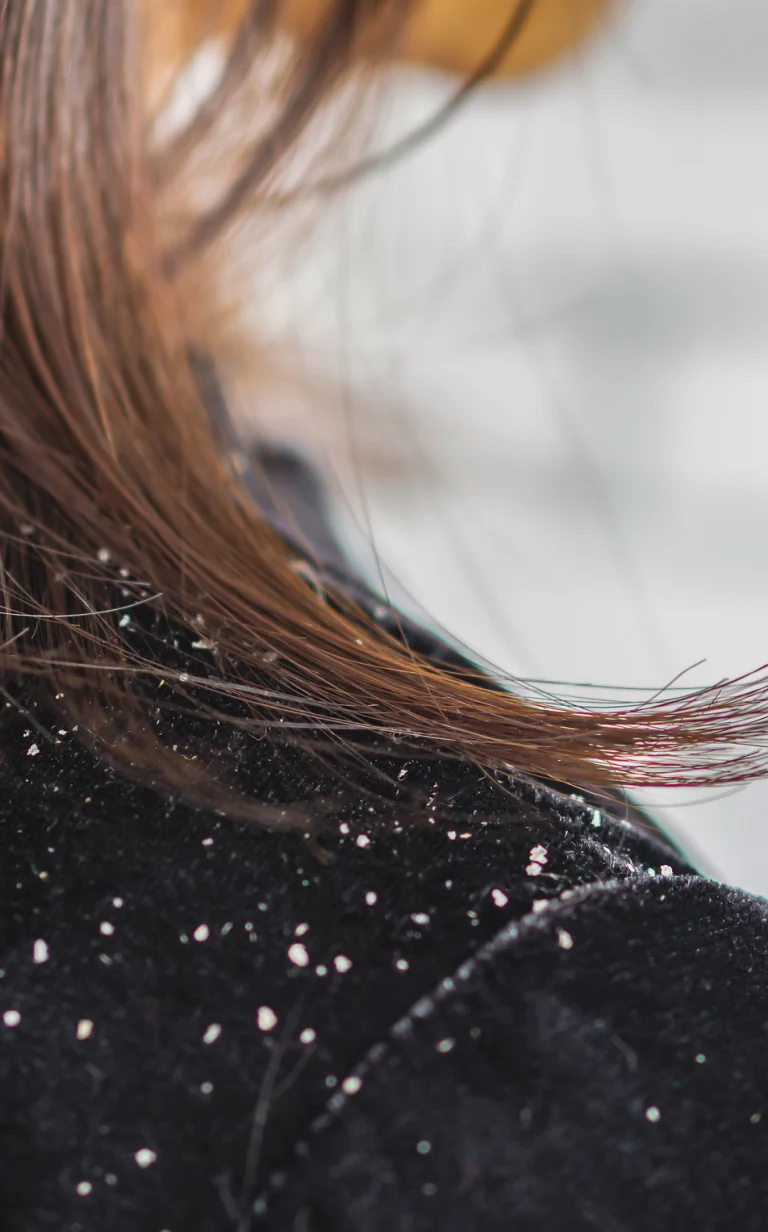 dandruff_img-768x1232
