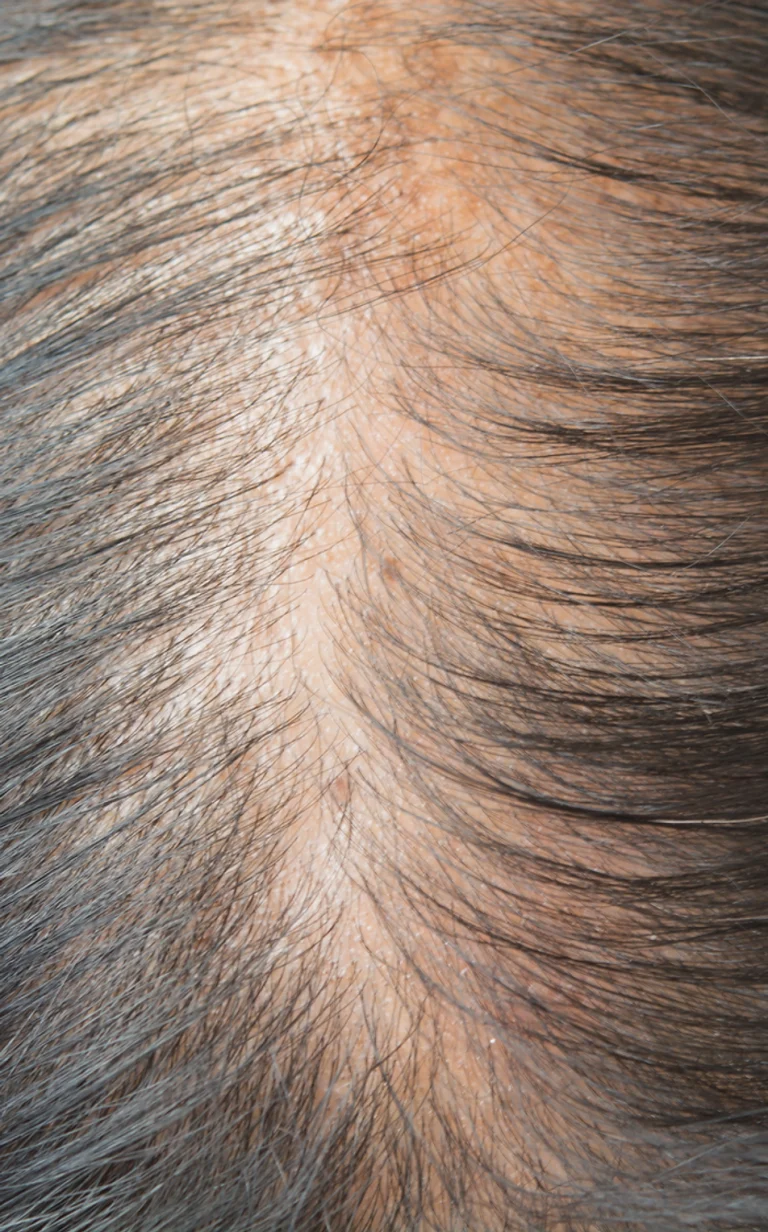 hair_loss_img-768x1232